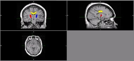 MRI images of the brain of someone who has recently had a stroke
